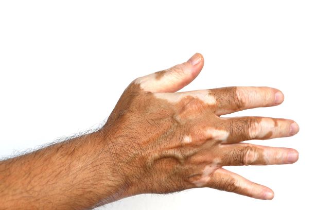 Joe Rogan hands - vitiligo